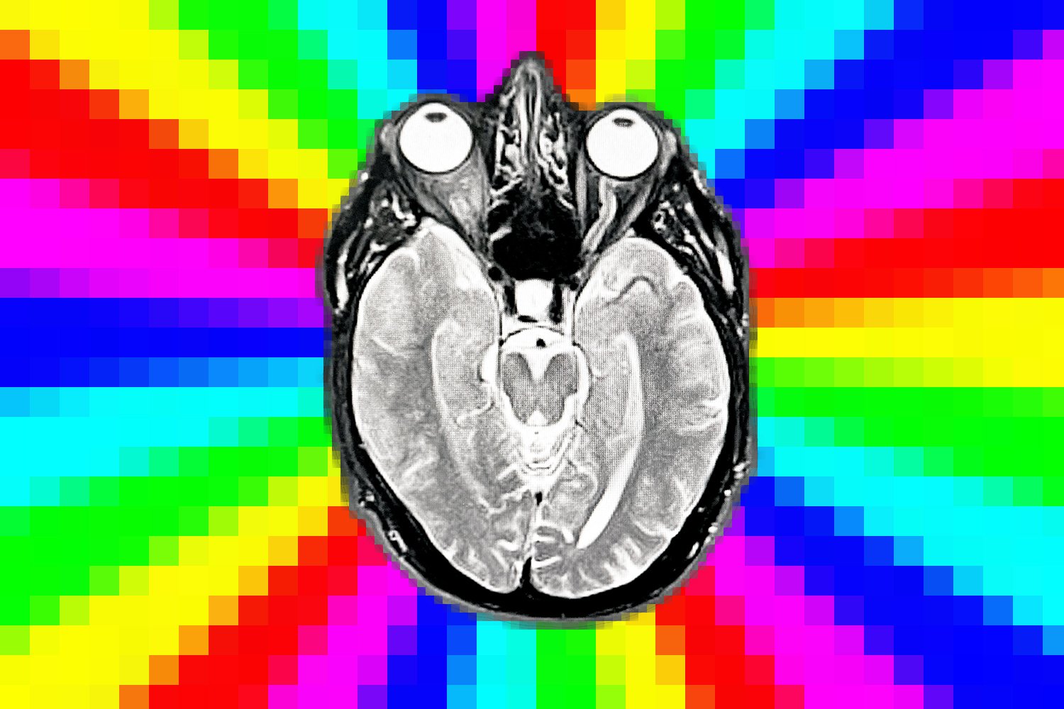 Mir Brain Scan Showing Early Dementia/alzheimer's